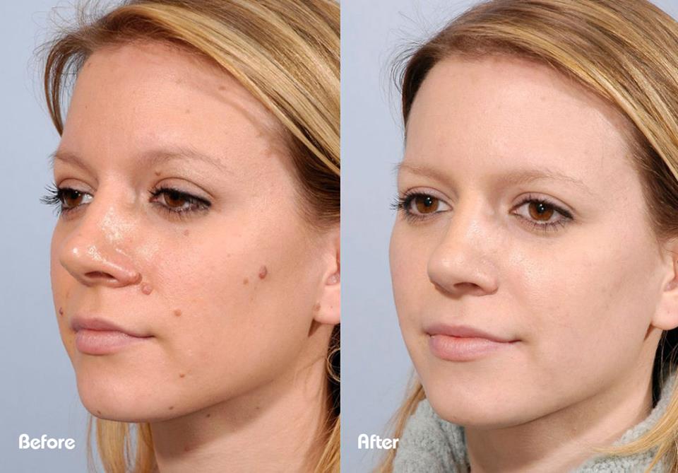 Benign mole before and after cryotherapy removal — Beau Synergy Ltd